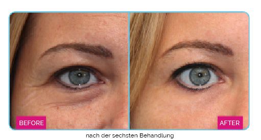 Dermatude Meta Therapy